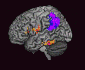 A closer look at what goes wrong in the brain when someone can’t spell