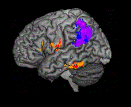 A closer look at what goes wrong in the brain when someone can’t spell